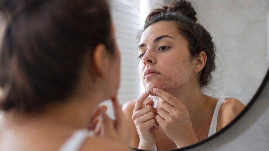 Hormonal acne on the chin with targeted skincare routine