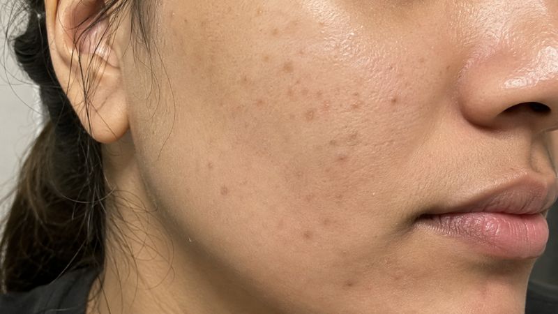 Serum for post-acne dark marks and uneven skin