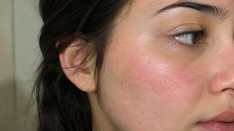 Mild facial redness caused by skin irritation